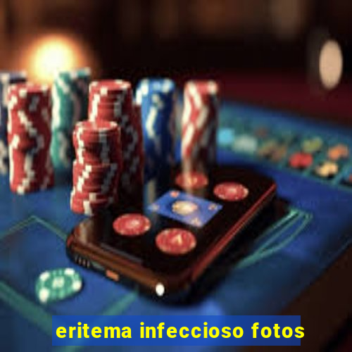 eritema infeccioso fotos